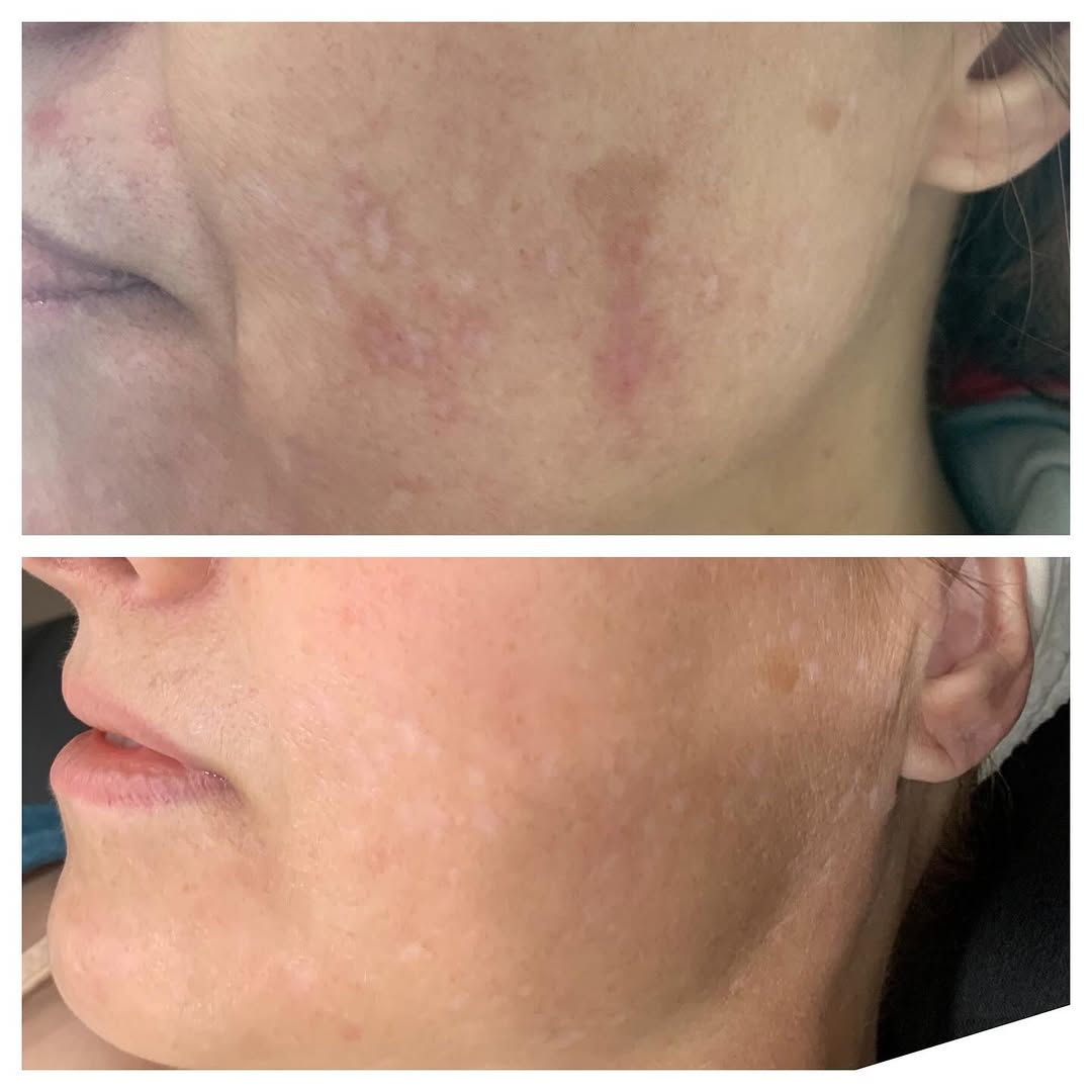 Side-by-side comparison showing the visible improvements from a 3D Skin Rejuvenation Treatment.