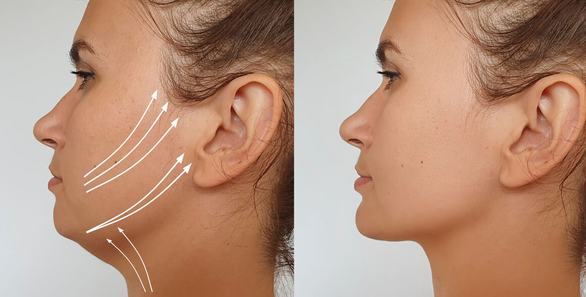Side profile showing a three-step progression of facial contouring and lifting results achieved with a Catiovital Facial.