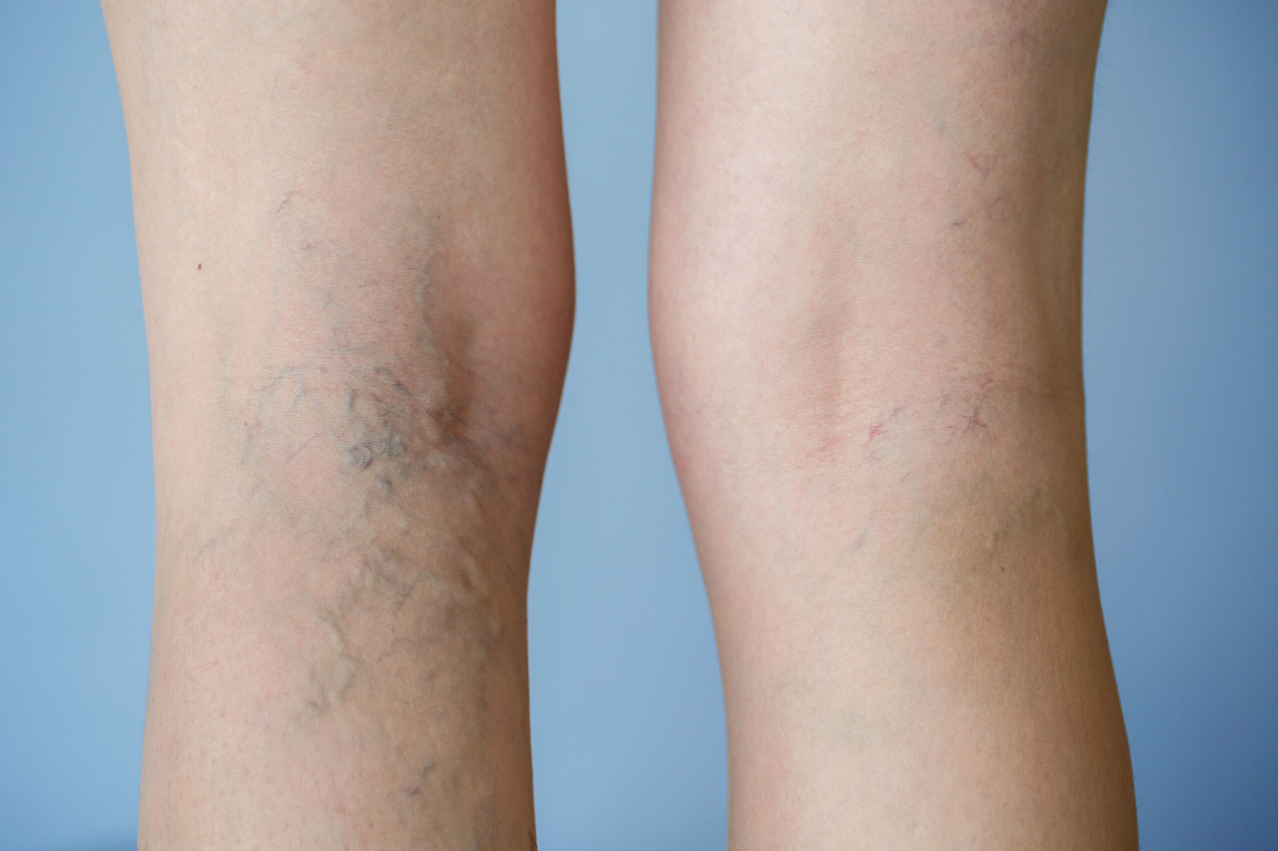 Back of legs showing before and after results of Laser Vein Therapy for vein reduction.