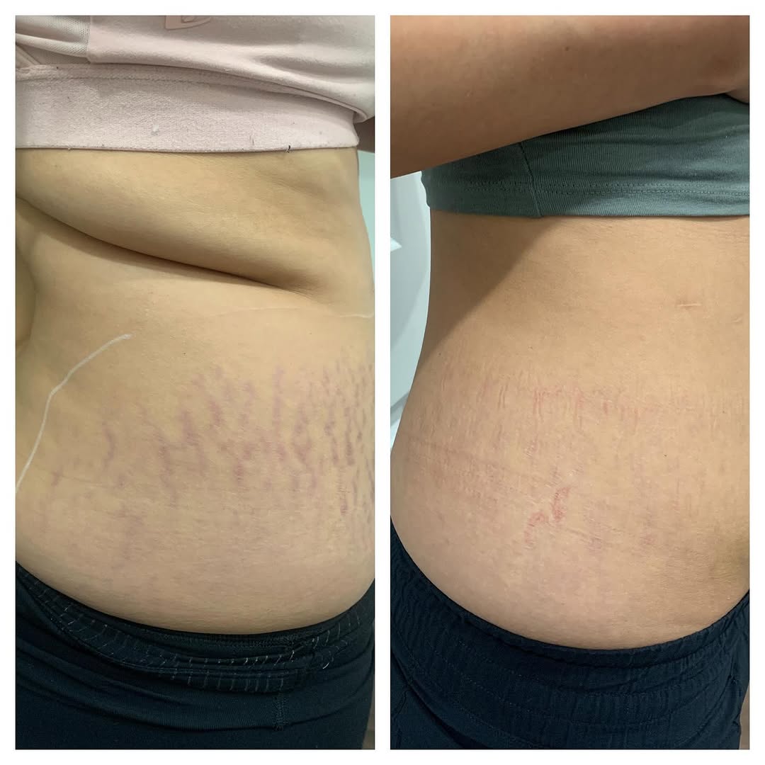 Side-by-side comparison of stretch marks and spider veins before and after Laser Vein Therapy on abdomen.