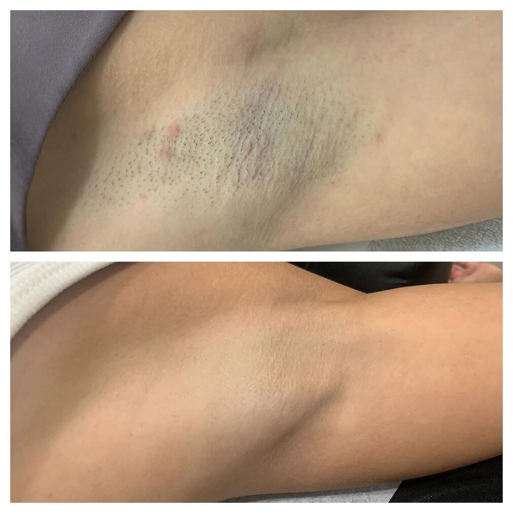 Comparison showing underarm before and after laser hair removal treatment, highlighting smoother skin.