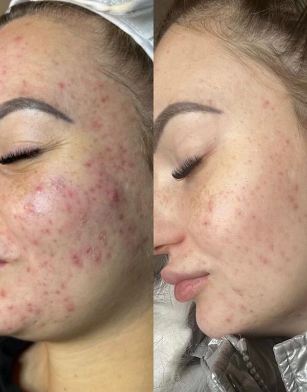 Before and after results of Liquid Microneedling treatment, highlighting improved skin texture and acne reduction.