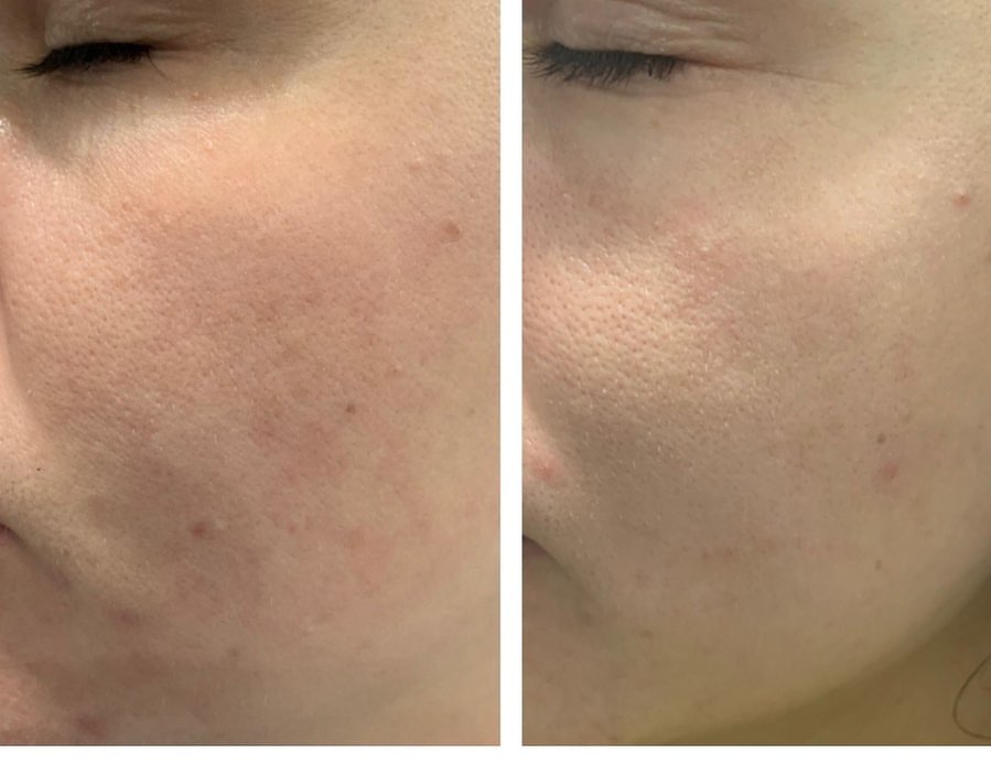 Side-by-side comparison of skin texture before and after microneedling treatment.