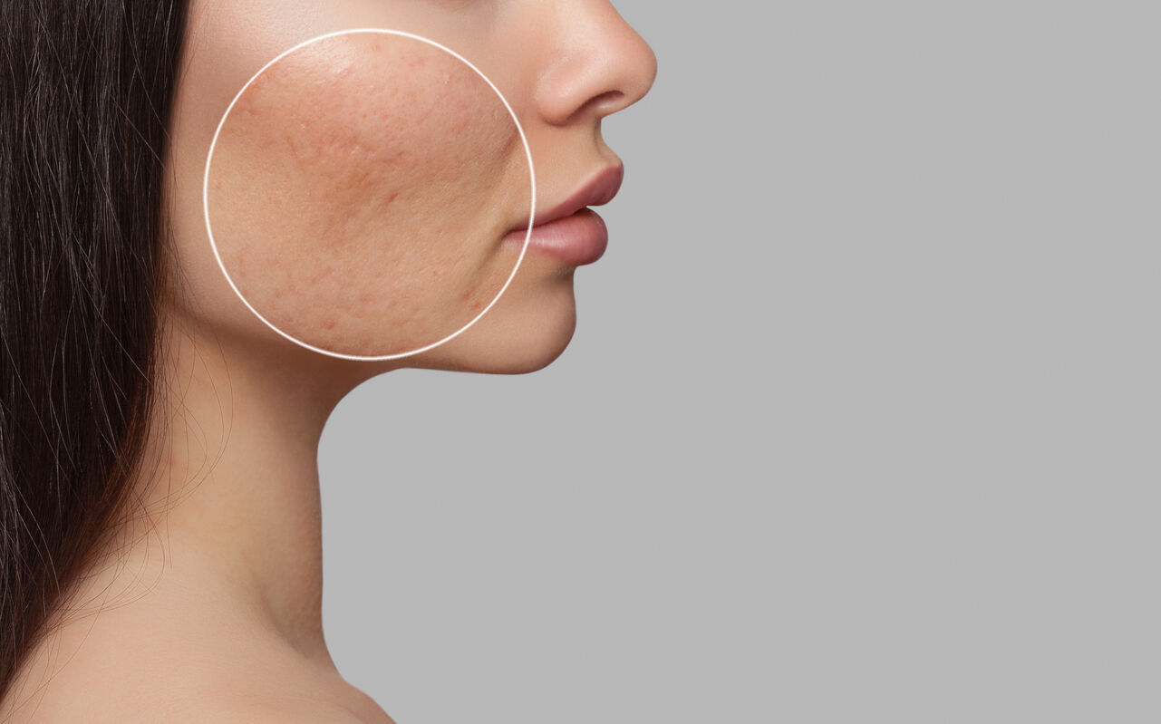 Close-up of a woman's cheek highlighting acne scars before microneedling treatment.