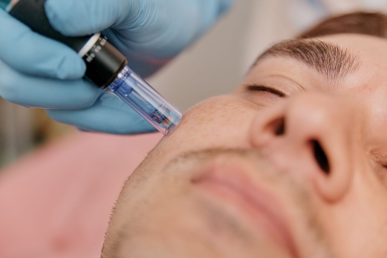 Male client receiving a microneedling treatment on the face to improve skin texture.