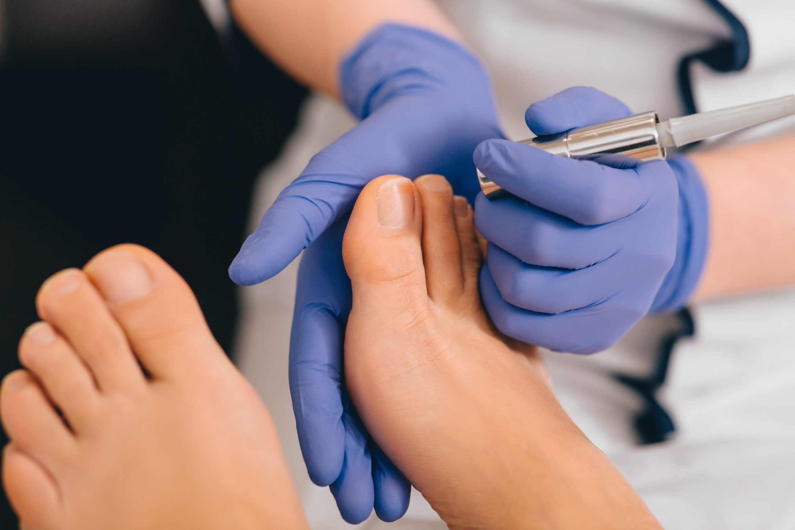 Nail Fungus Treatment being carried out with precision tools to restore nail health.