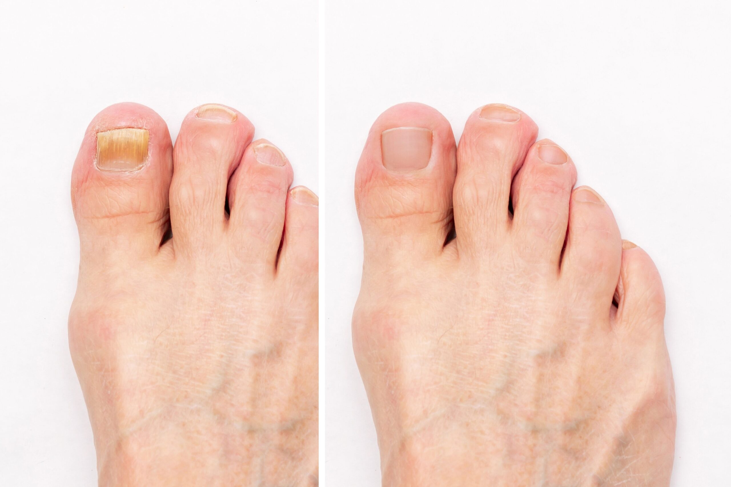 Comparison showing before and after results of Nail Fungus Treatment on a patient's toenails.
