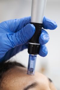 patient undergoing microneedling procedure